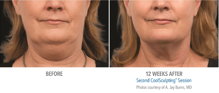 CoolSculpting® Before and After Pictures Knoxville, Tennessee