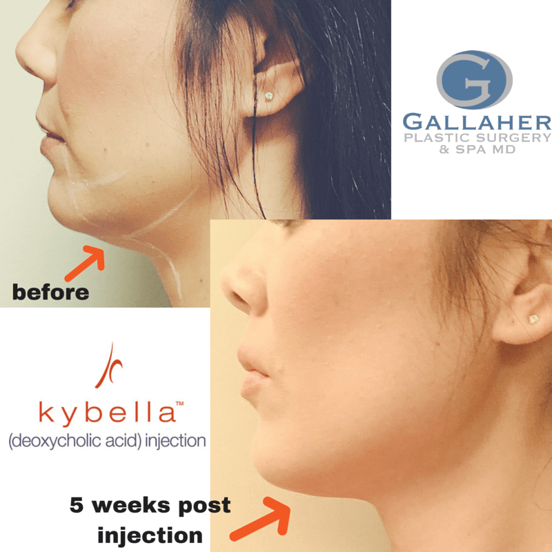 Kybella® in Knoxville, Tennessee