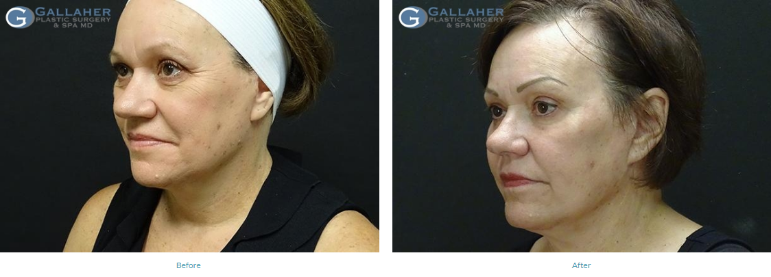 Laser Skin Resurfacing Before and After Pictures Knoxville, Tennessee