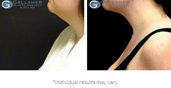 Liposuction Before and After Pictures Knoxville, Tennessee