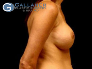 Plastic Surgery Before and After Pictures in Knoxville, Tennessee