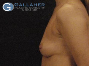 Plastic Surgery Before and After Pictures in Knoxville, Tennessee