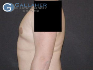 Plastic Surgery Before and After Pictures in Knoxville, Tennessee