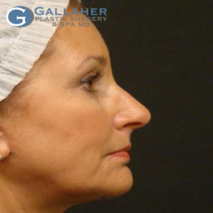 Plastic Surgery Before and After Pictures in Knoxville, Tennessee