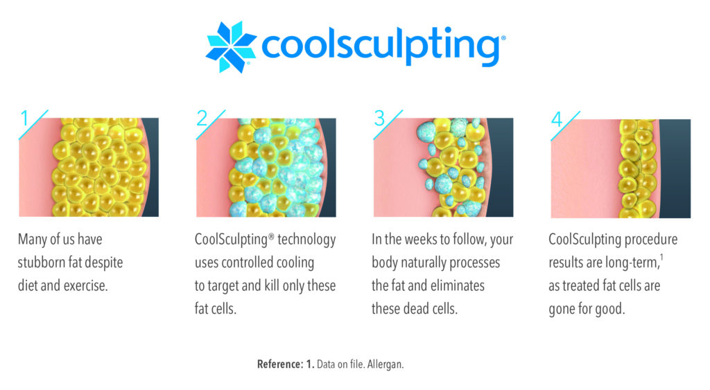 Illustration of how CoolScultping destroys and eliminates fat cells.