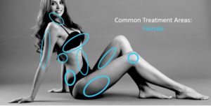 BodyTite Treatment Areas for Women