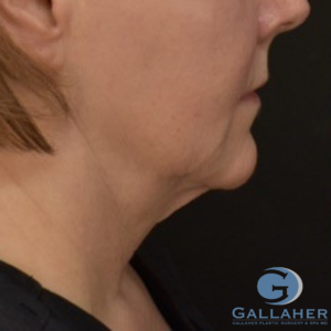 Plastic Surgery Before and After Pictures in Knoxville, Tennessee