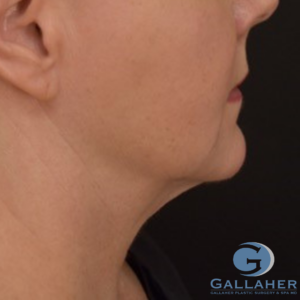 Plastic Surgery Before and After Pictures in Knoxville, Tennessee