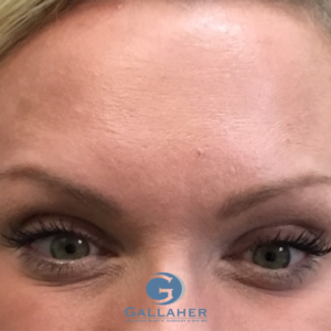 Plastic Surgery Before and After Pictures in Knoxville, Tennessee