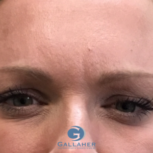 Plastic Surgery Before and After Pictures in Knoxville, Tennessee