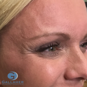 Plastic Surgery Before and After Pictures in Knoxville, Tennessee
