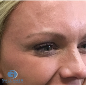 Plastic Surgery Before and After Pictures in Knoxville, Tennessee