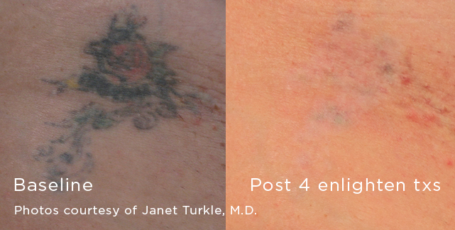 enlighten laser tattoo removal before & after