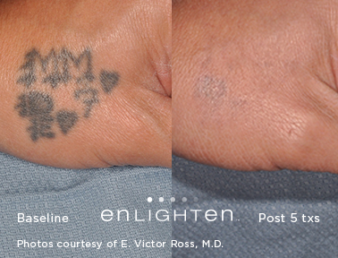 enlighten laser tattoo removal before & after
