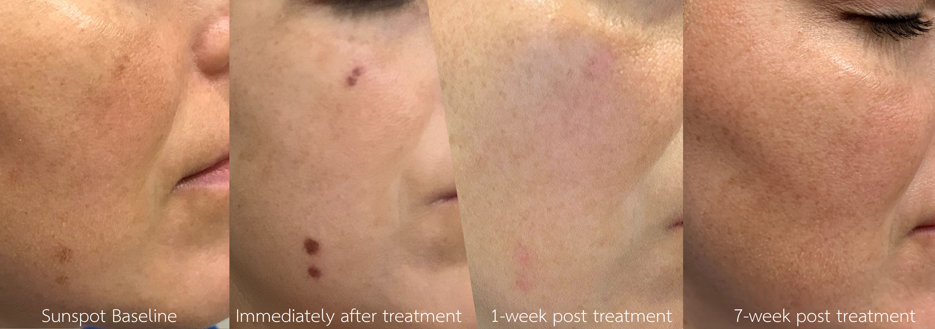 CryoCorrect sun spot before & after