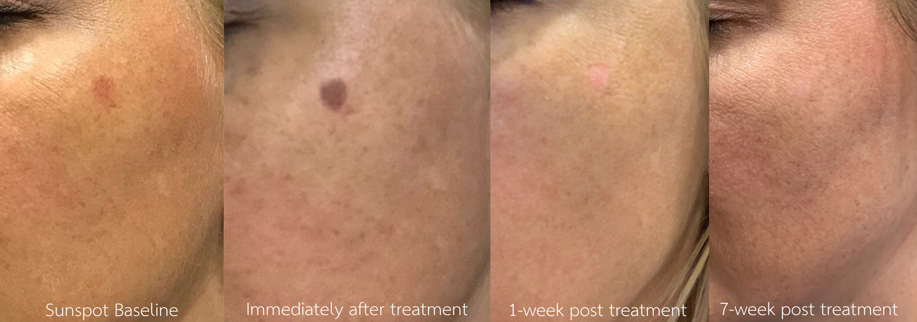 CryoCorrect sun spot before & after