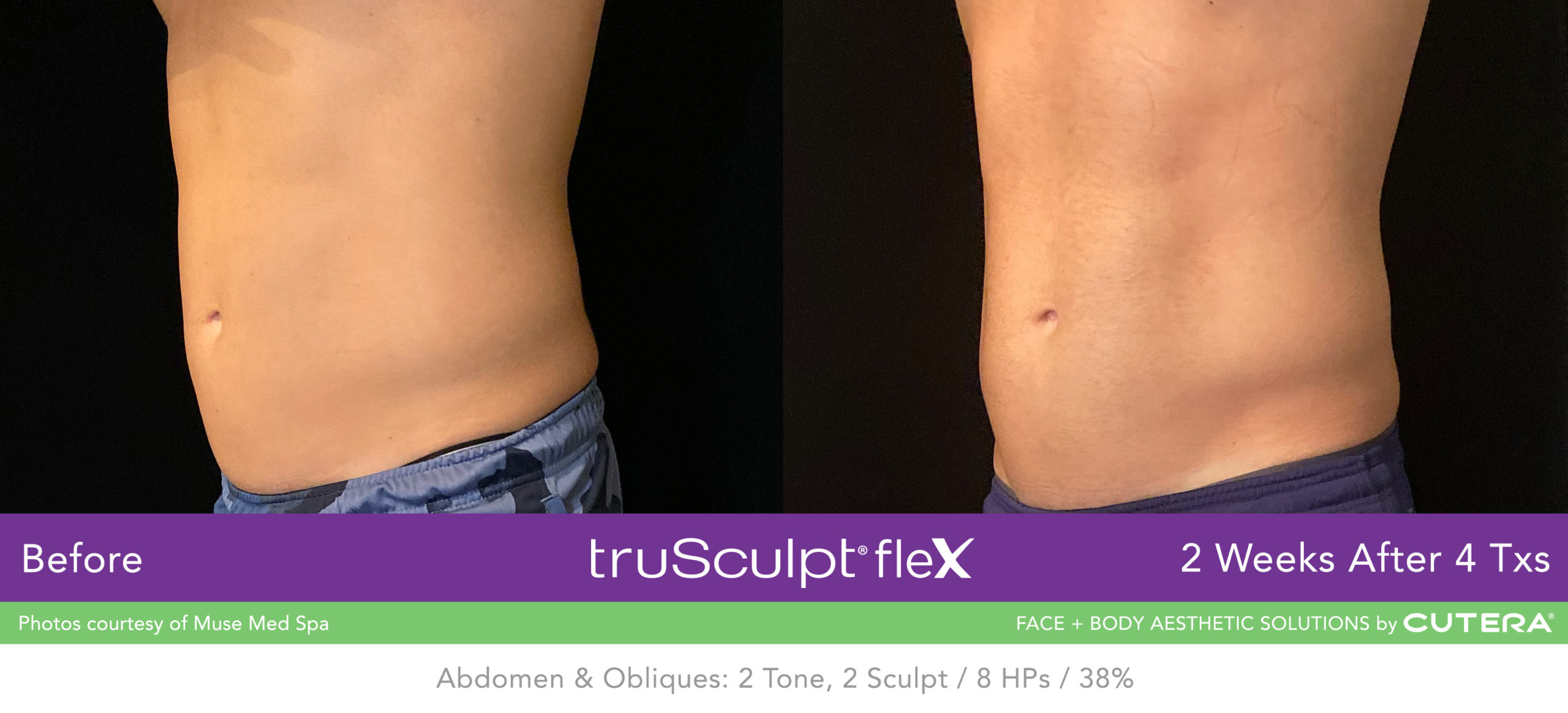 TruSculpt® Flex Before and After Pictures Knoxville, Tennessee