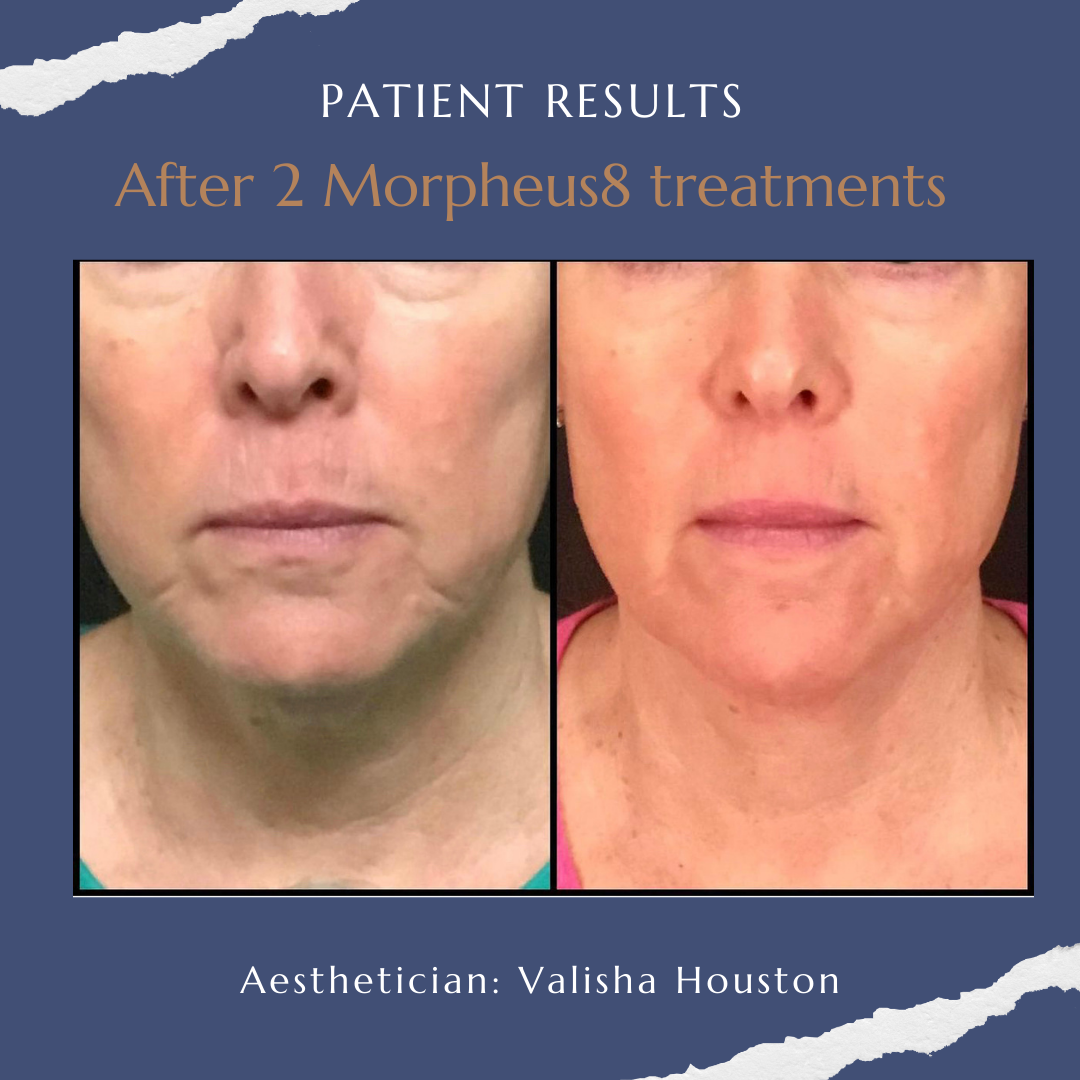 Morpheus8 Knoxville Tn Microneedling Gallaher Plastic Surgery Spa Md