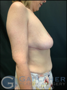 Plastic Surgery Before and After Pictures in Knoxville, Tennessee