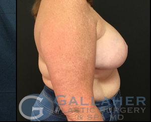 Plastic Surgery Before and After Pictures in Knoxville, Tennessee