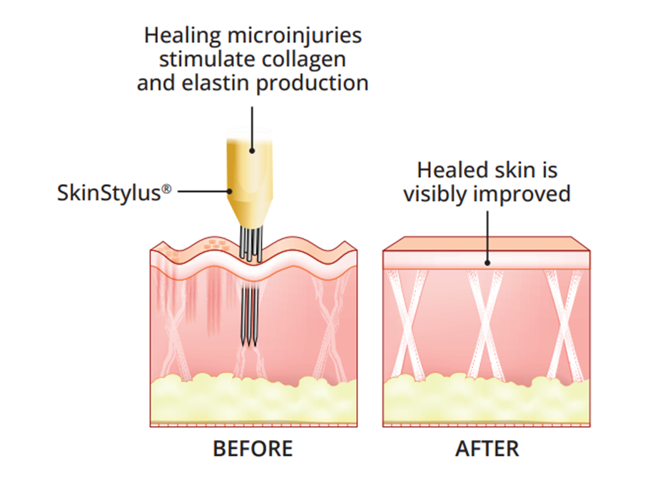 SkinStylus-before-after