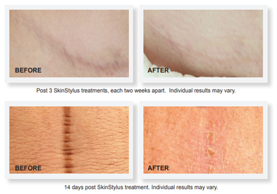 SkinStylus-before-after1