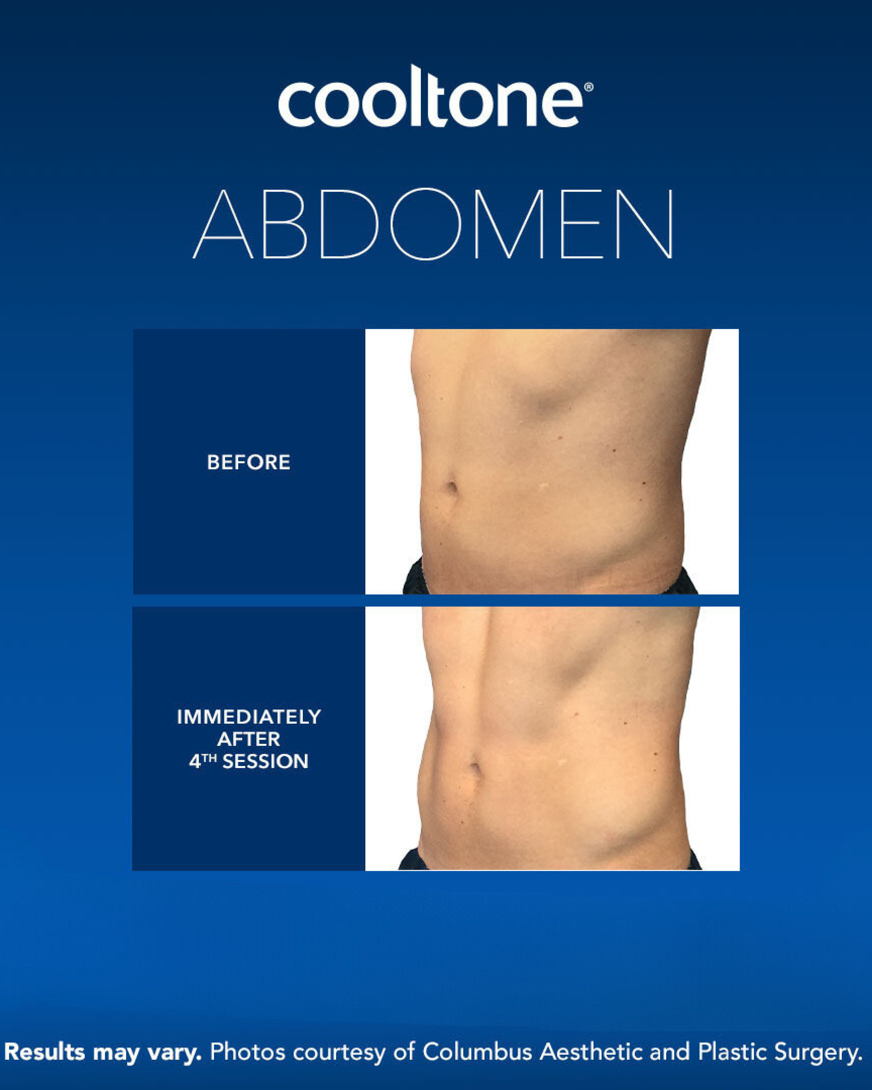 CoolTone-Abdomen CoolTone Abdomen