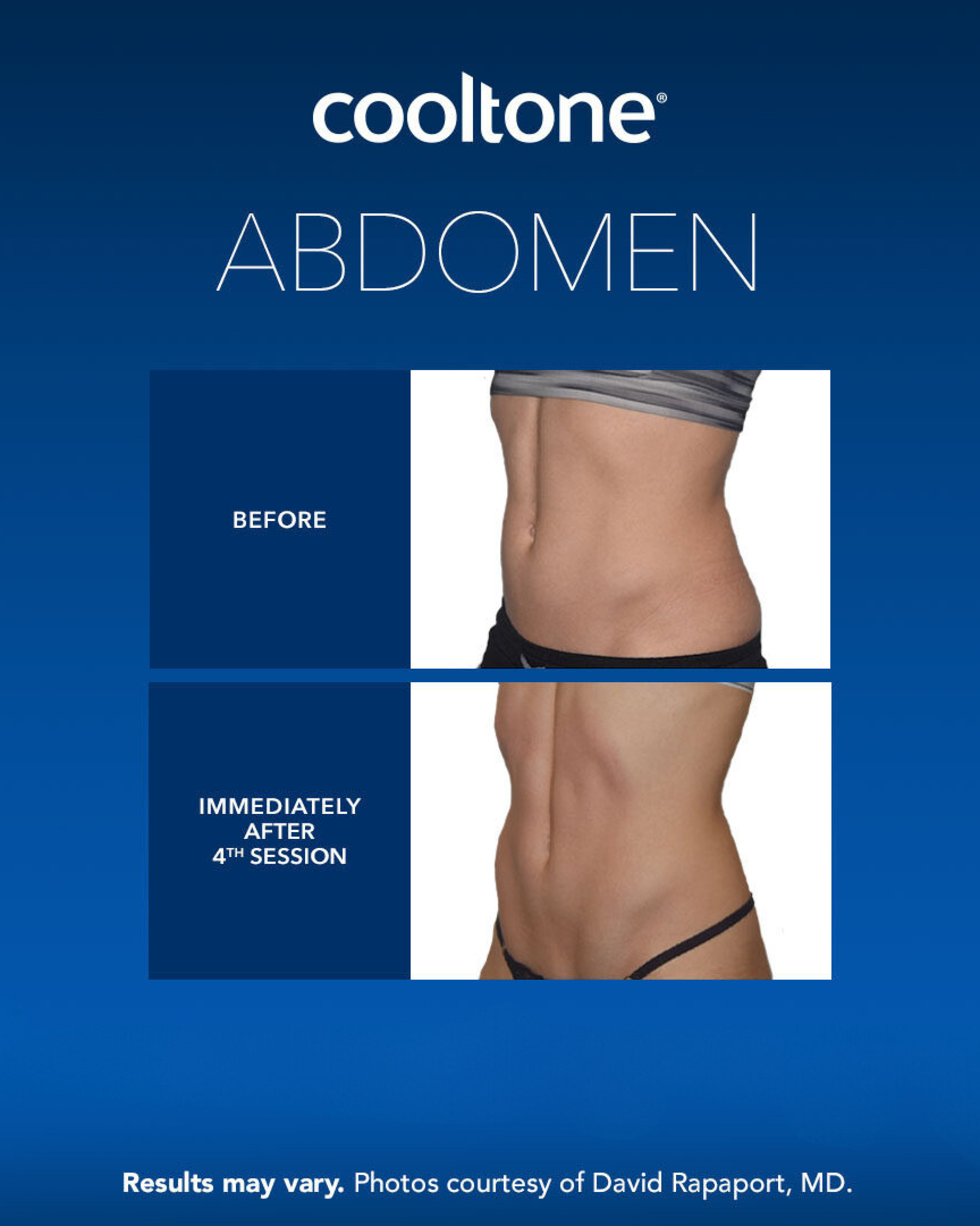CoolTone-Abdomen CoolTone Abdomen