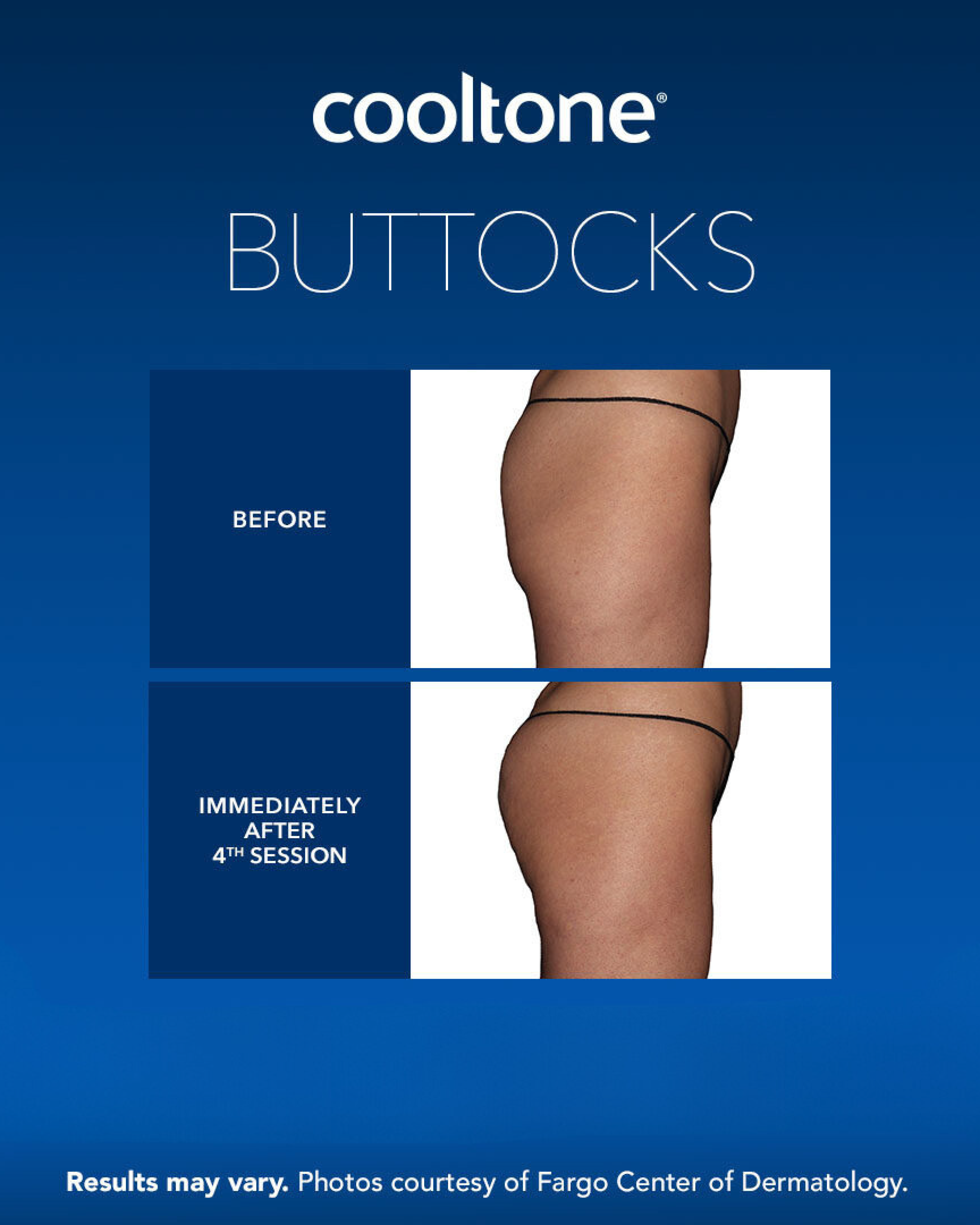 CoolTone-Buttocks CoolTone-Buttocks