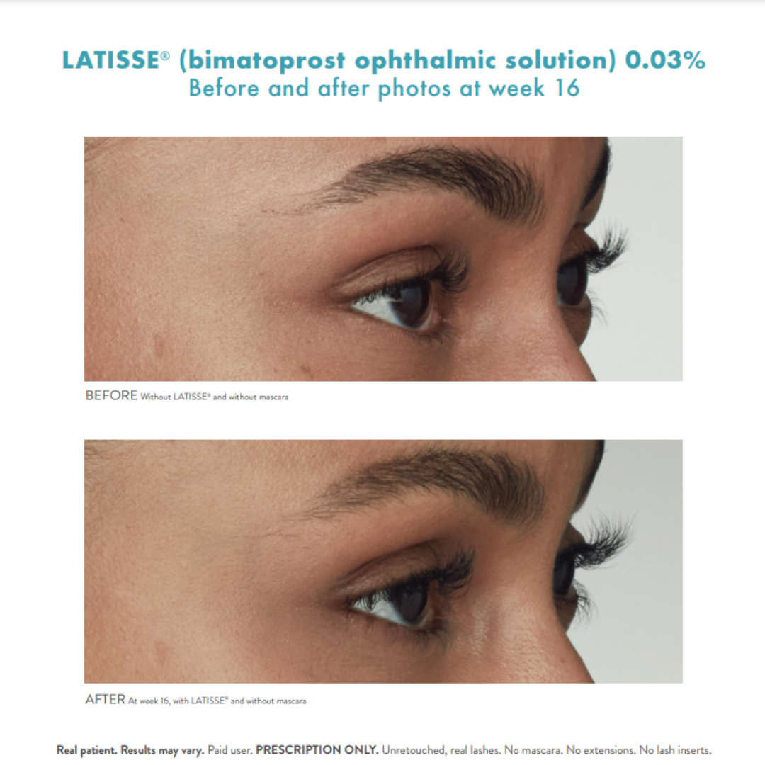 Latisse (3)